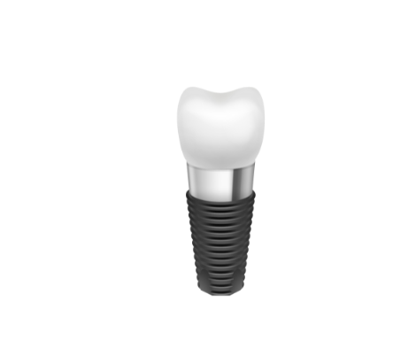 Zubní implantáty1
